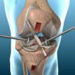 acl reconstruction surgery
