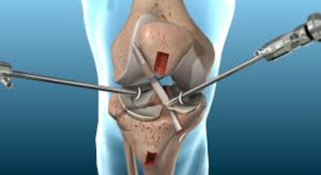 acl reconstruction surgery