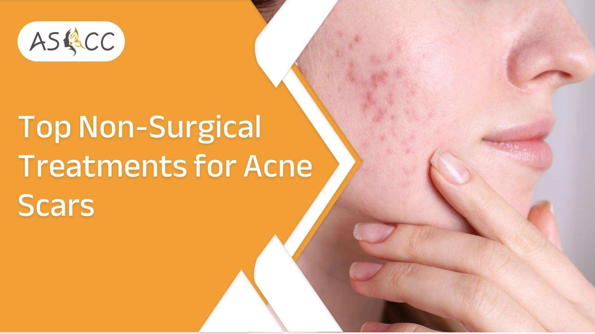 best acne scar treatment in jaipur
