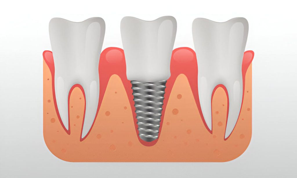 dental implants