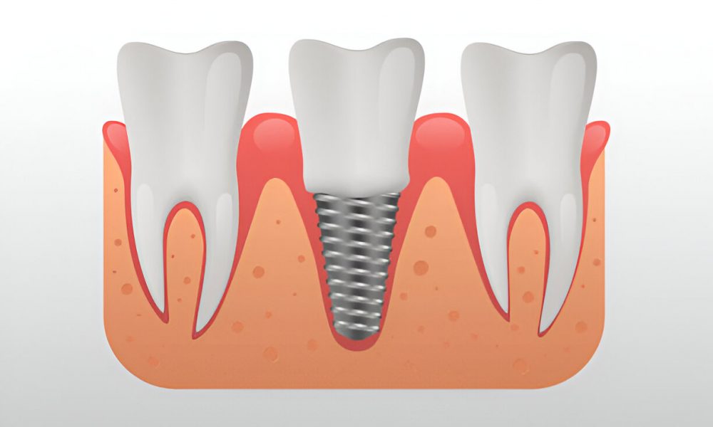 dental implants