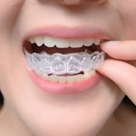 eat and drink with Invisalign aligners