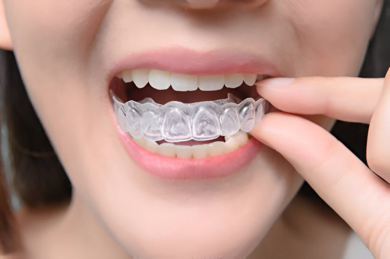 When wearing my Invisalign® aligners, is it okay for me to eat and drink?