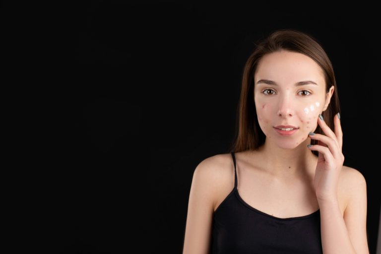 How to Treat Teen Acne Without Harsh Chemicals