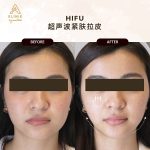 hifu treatment kl
