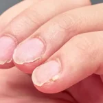 nevus dermatology