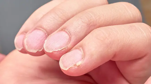 nevus dermatology