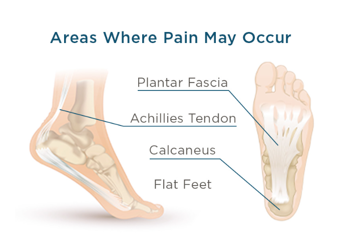 Walk Better with Proper Foot Arch Support for Flat Feet