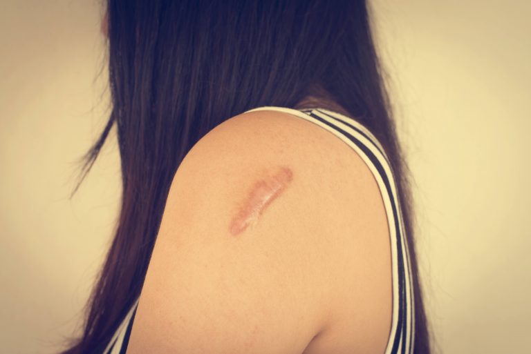 How to Remove Old Wound Scars: 10 Proven Ways to Fade Marks Naturally and Medically
