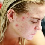 tretinoin for acne scars