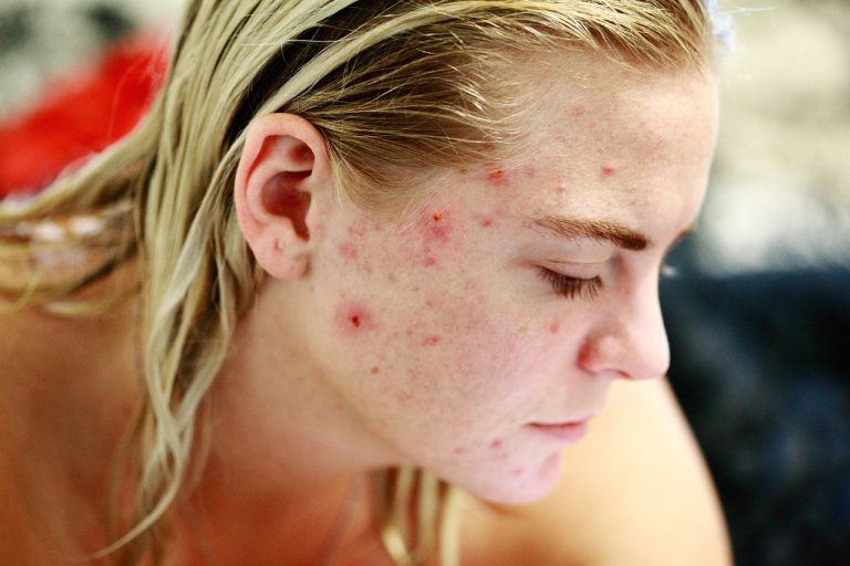 Does Tretinoin Help With Acne Scars?