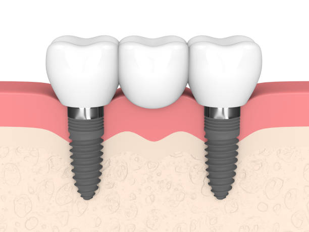Dental Implants