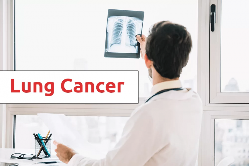 lung cancer treatment