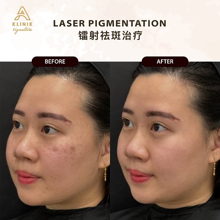 Who is the Best for Laser Dark Spot Removal in Kuala Lumpur Malaysia?