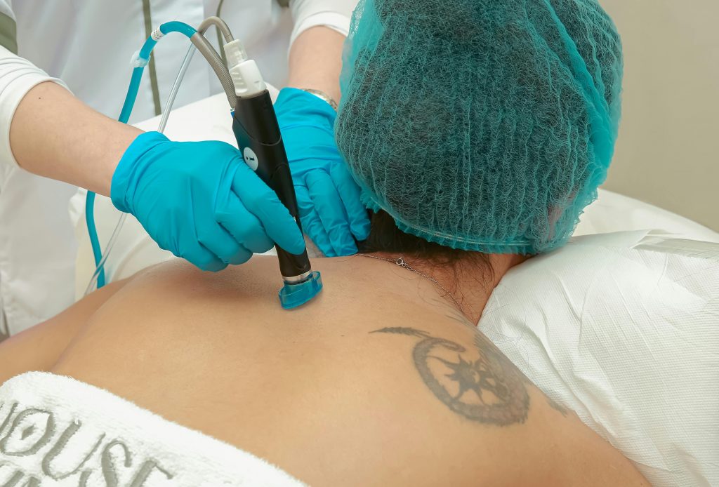 tattoo removal