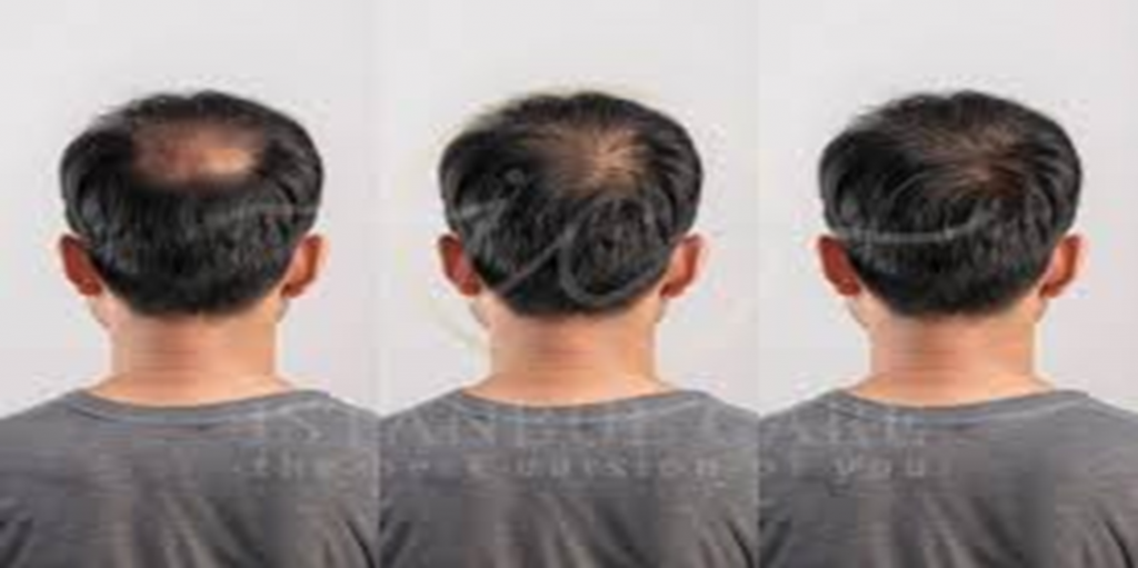 hair regrowth for men