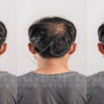 hair regrowth for men