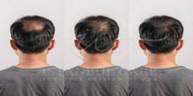 Hair Regrowth for Men: Effective Treatments That Really Work