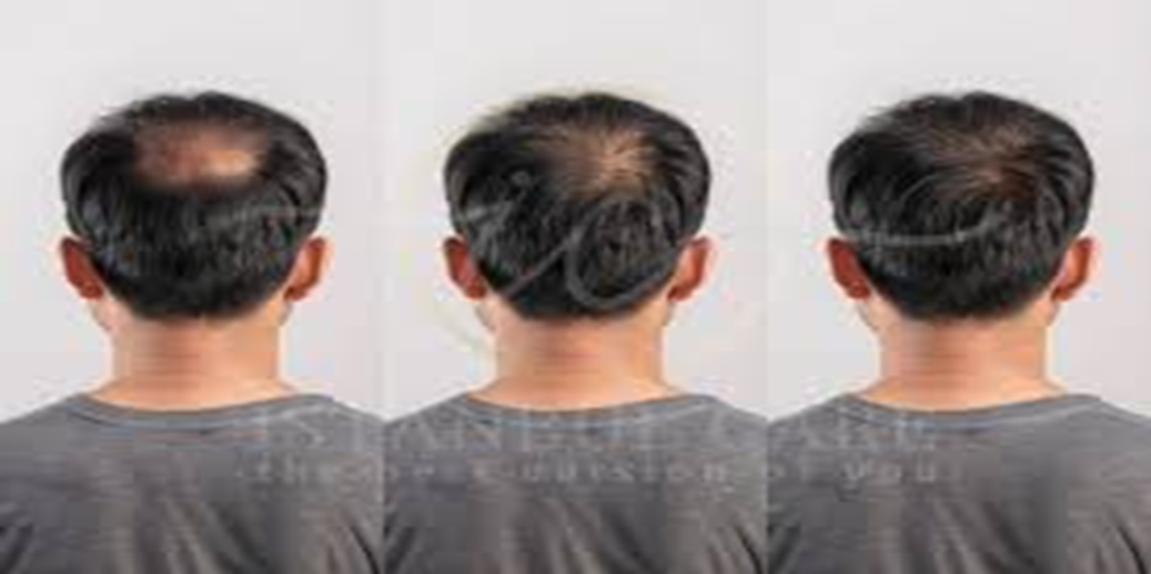 hair regrowth for men