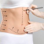 liposuction