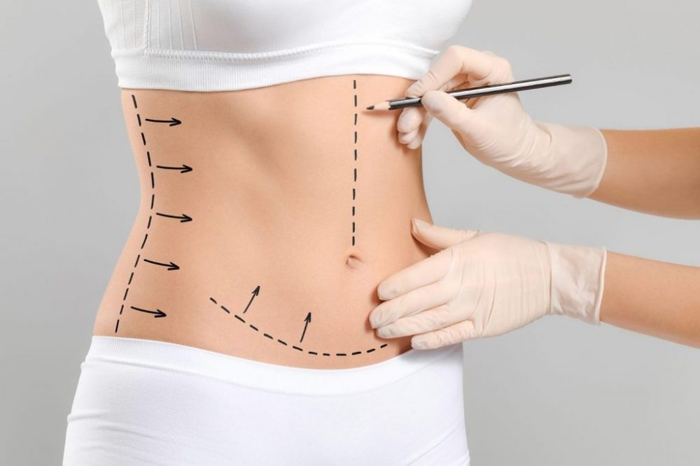 liposuction