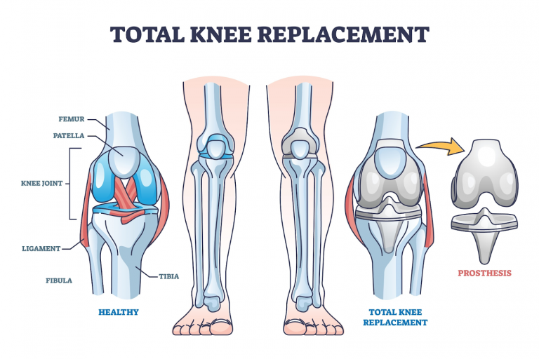 Knee Pain Relief: Expert Causes, Symptoms & Treatments