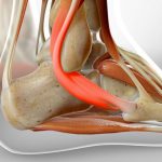 peroneal tendonitis treatment