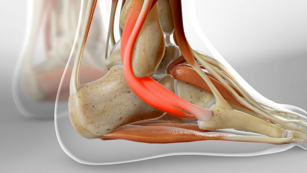 peroneal tendonitis treatment