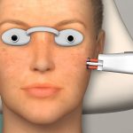 laser skin resurfacing boynton beach