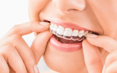 invisalign in hyderabad