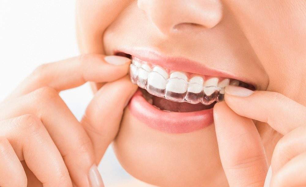 invisalign in hyderabad