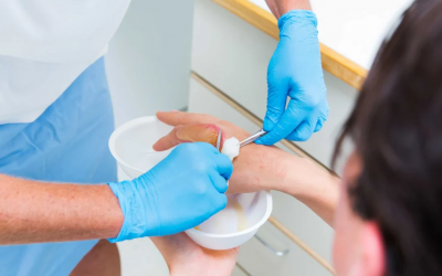 burn treatment