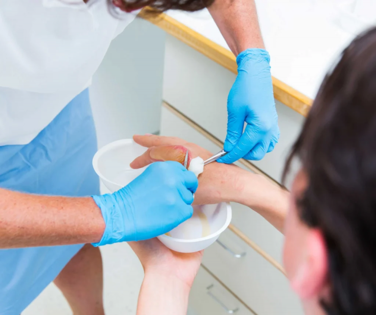 7 Powerful Burn Treatment Near Me Tips for Fast Healing