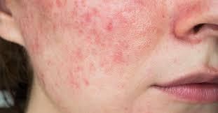 Best Facial Ingredients for Calming Rosacea-Prone Skin