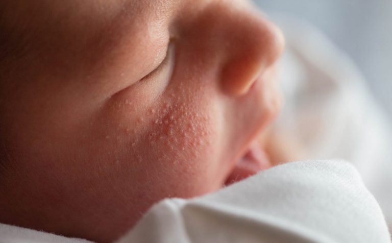 What Is the Best Way for Milia Removal?